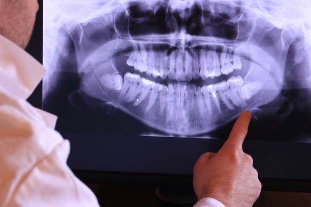 Best Emergency Wisdom Tooth Extraction in Fife, WA